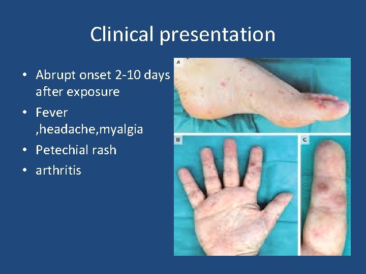 Clinical presentation • Abrupt onset 2 -10 days after exposure • Fever , headache,