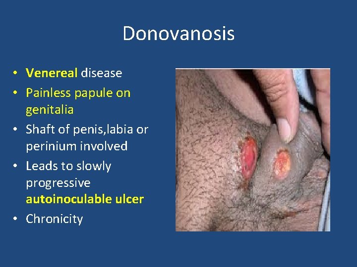 Donovanosis • Venereal disease • Painless papule on genitalia • Shaft of penis, labia