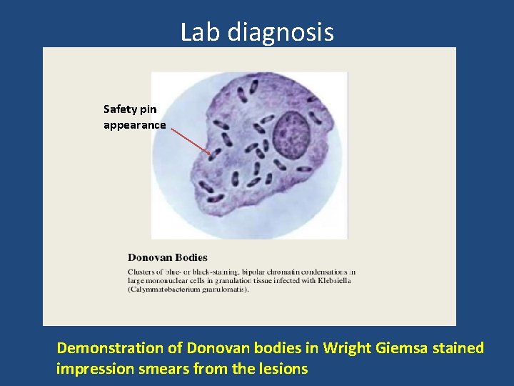 Lab diagnosis Safety pin appearance Demonstration of Donovan bodies in Wright Giemsa stained impression