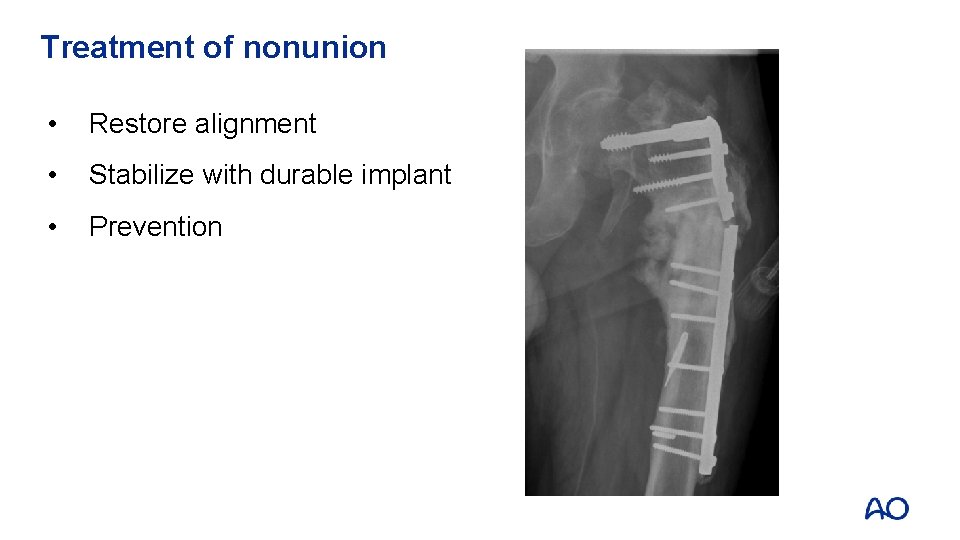 Treatment of nonunion • Restore alignment • Stabilize with durable implant • Prevention 