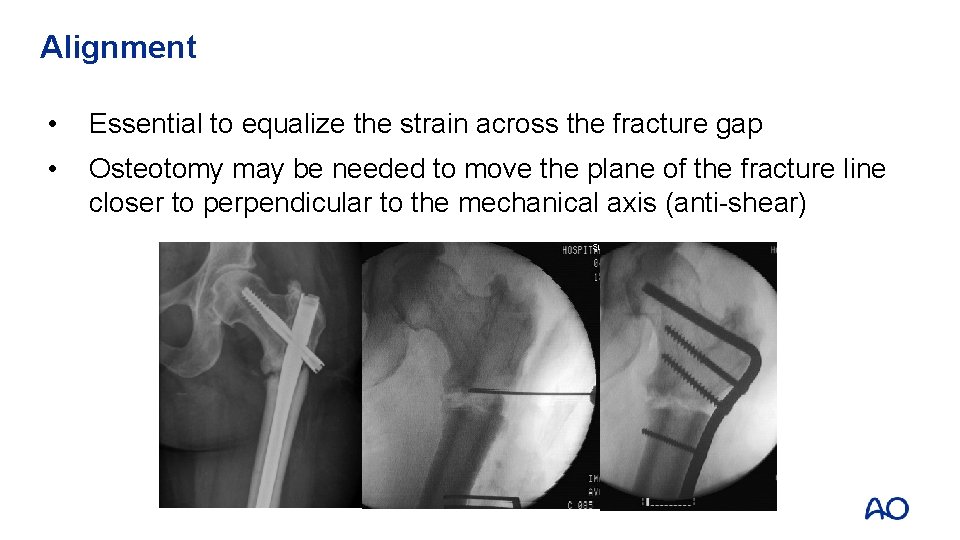 Alignment • Essential to equalize the strain across the fracture gap • Osteotomy may