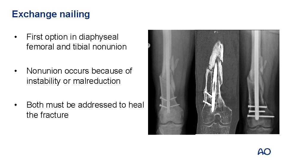 Exchange nailing • First option in diaphyseal femoral and tibial nonunion • Nonunion occurs
