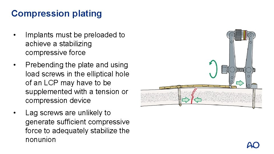 Compression plating • Implants must be preloaded to achieve a stabilizing compressive force •