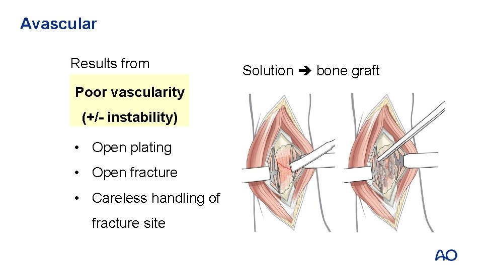 Avascular Results from Poor vascularity (+/- instability) • Open plating • Open fracture •