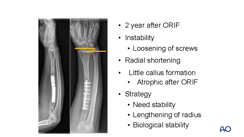  • 2 year after ORIF • Instability • Loosening of screws • Radial
