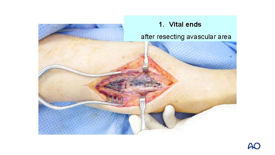 1. Vital ends after resecting avascular area 