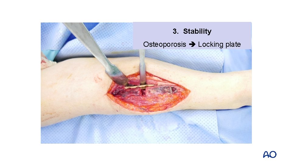 3. Stability Osteoporosis Locking plate 