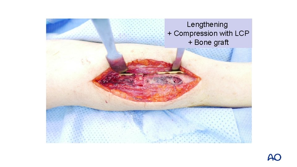 Lengthening + Compression with LCP + Bone graft 