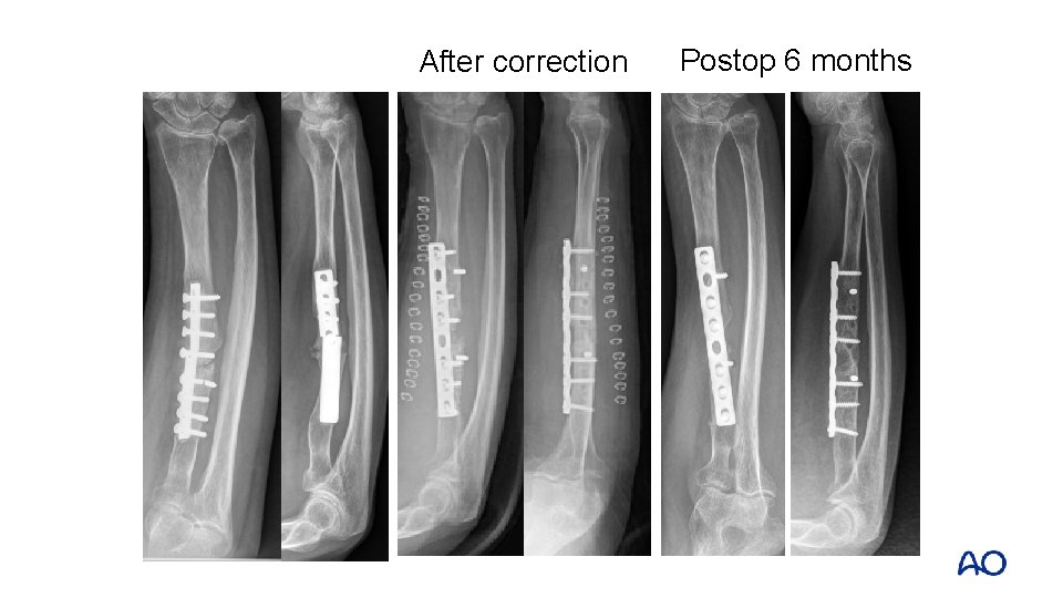 After correction Postop 6 months 