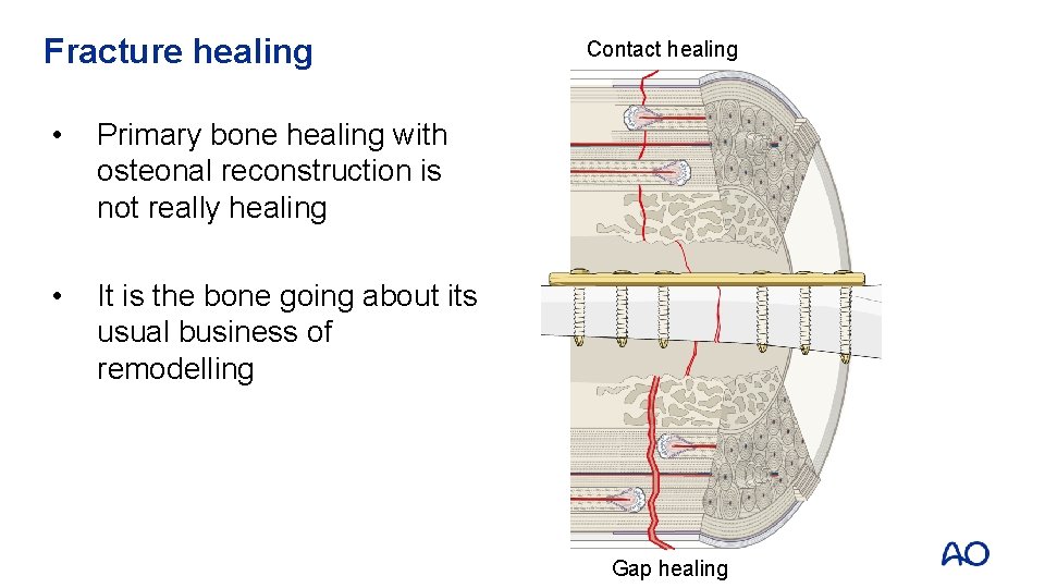 Fracture healing • Primary bone healing with osteonal reconstruction is not really healing •