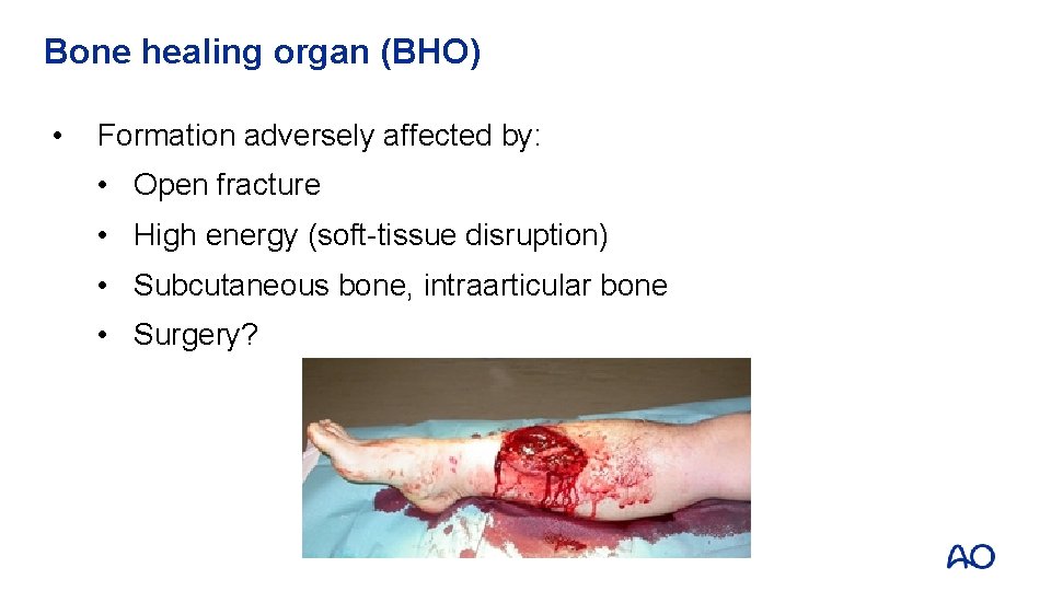Bone healing organ (BHO) • Formation adversely affected by: • Open fracture • High