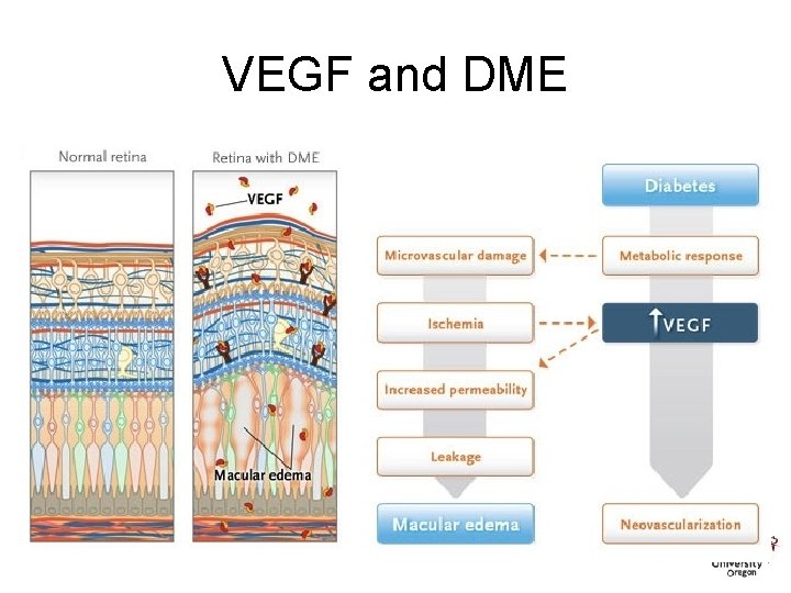 VEGF and DME 