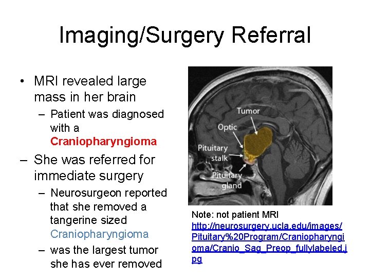 Imaging/Surgery Referral • MRI revealed large mass in her brain – Patient was diagnosed