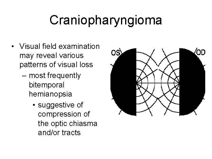 Craniopharyngioma • Visual field examination may reveal various patterns of visual loss – most