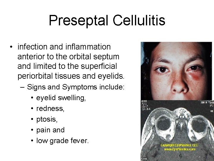Preseptal Cellulitis • infection and inflammation anterior to the orbital septum and limited to