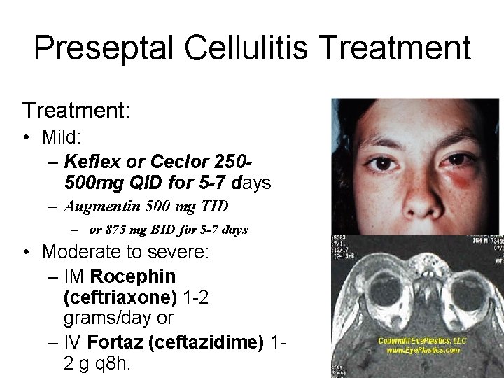 Preseptal Cellulitis Treatment: • Mild: – Keflex or Ceclor 250500 mg QID for 5