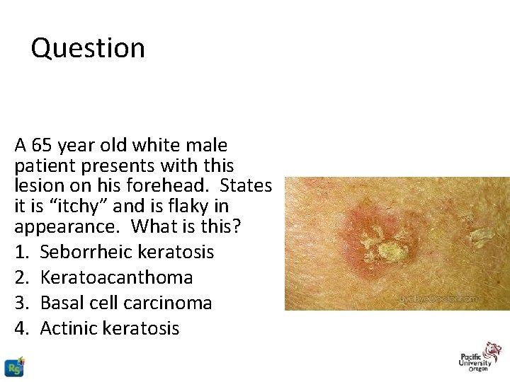 Question A 65 year old white male patient presents with this lesion on his