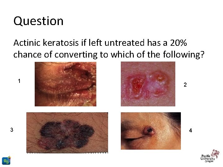 Question Actinic keratosis if left untreated has a 20% chance of converting to which