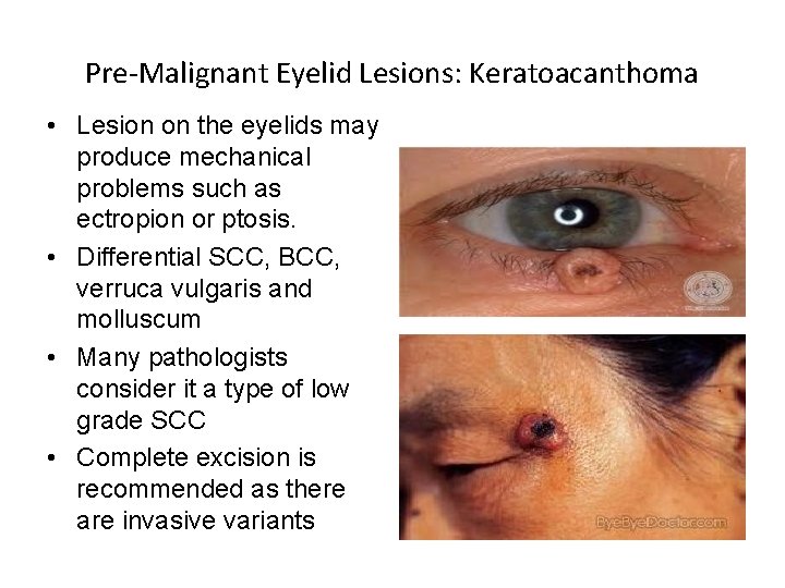 Pre-Malignant Eyelid Lesions: Keratoacanthoma • Lesion on the eyelids may produce mechanical problems such
