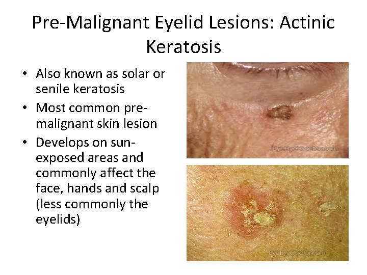 Pre-Malignant Eyelid Lesions: Actinic Keratosis • Also known as solar or senile keratosis •