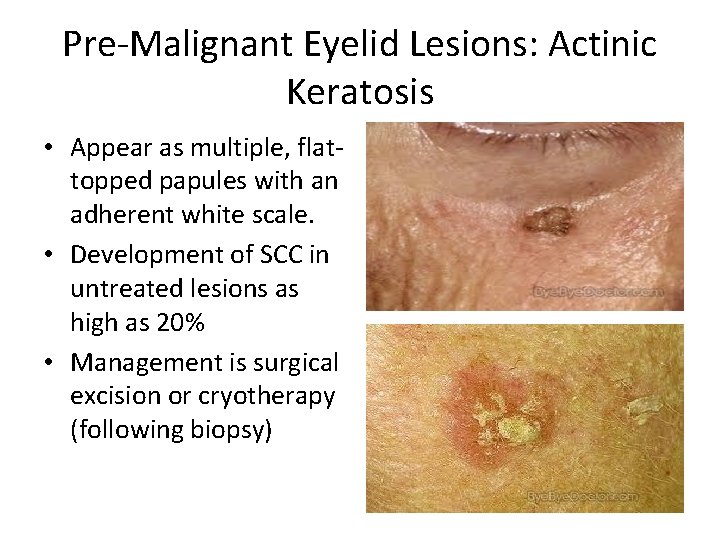 Pre-Malignant Eyelid Lesions: Actinic Keratosis • Appear as multiple, flattopped papules with an adherent