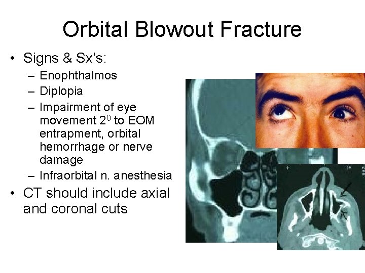 Orbital Blowout Fracture • Signs & Sx’s: – Enophthalmos – Diplopia – Impairment of