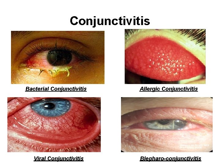 Conjunctivitis Bacterial Conjunctivitis Viral Conjunctivitis Allergic Conjunctivitis Blepharo-conjunctivitis 