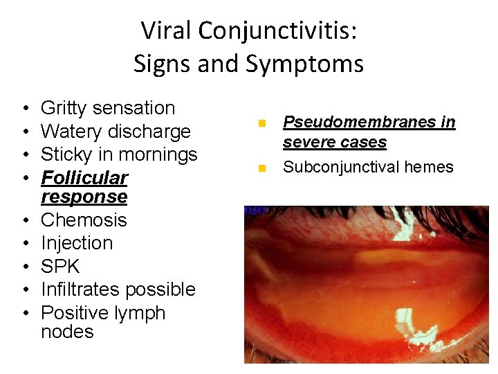 Viral Conjunctivitis: Signs and Symptoms • • • Gritty sensation Watery discharge Sticky in
