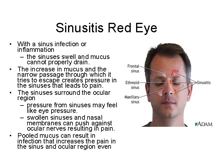 Sinusitis Red Eye • With a sinus infection or inflammation – the sinuses swell