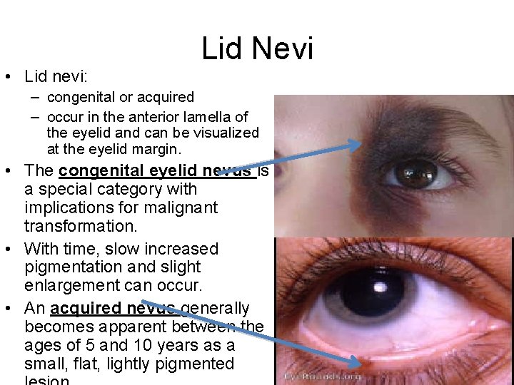 Lid Nevi • Lid nevi: – congenital or acquired – occur in the anterior
