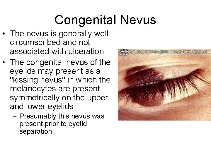 Congenital Nevus • The nevus is generally well circumscribed and not associated with ulceration.