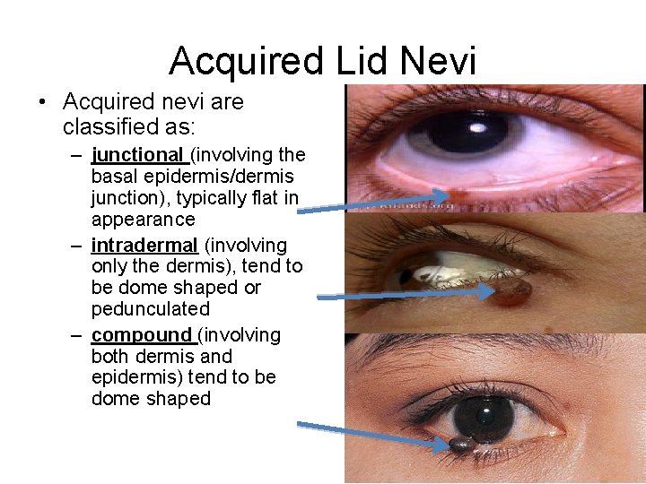 Acquired Lid Nevi • Acquired nevi are classified as: – junctional (involving the basal