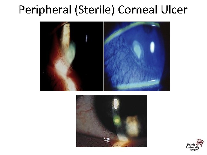 Peripheral (Sterile) Corneal Ulcer 