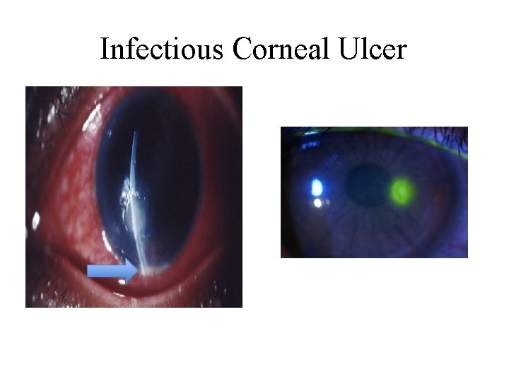 Infectious Corneal Ulcer 