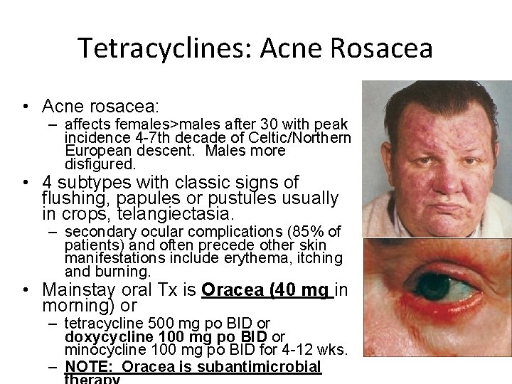 Tetracyclines: Acne Rosacea • Acne rosacea: – affects females>males after 30 with peak incidence