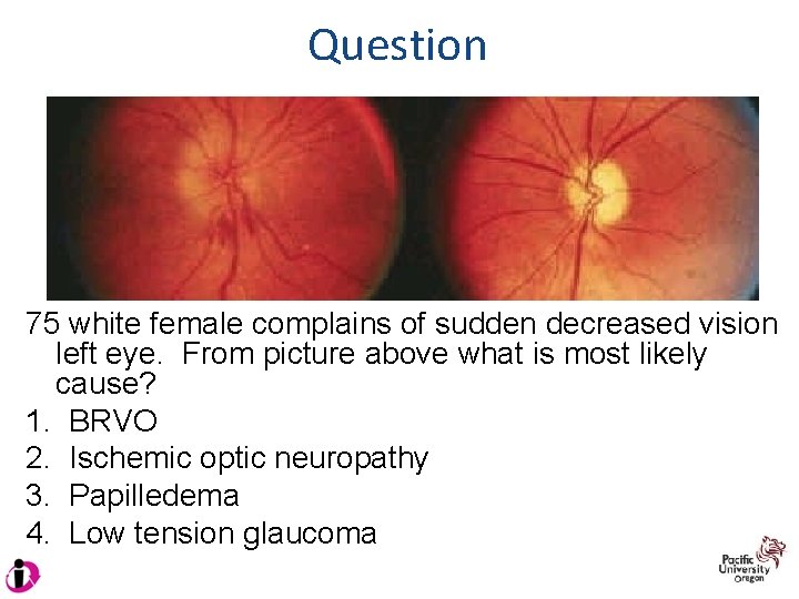 Question 75 white female complains of sudden decreased vision left eye. From picture above