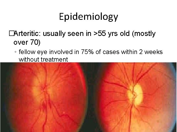 Epidemiology �Arteritic: usually seen in >55 yrs old (mostly over 70) ◦ fellow eye