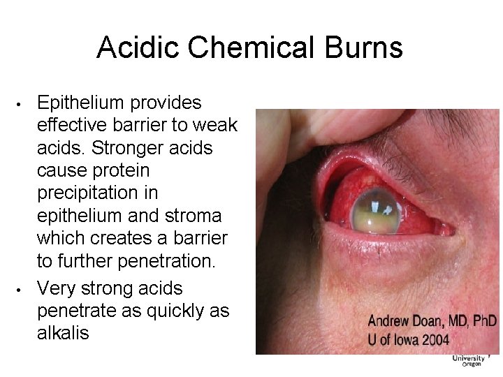 Acidic Chemical Burns • • Epithelium provides effective barrier to weak acids. Stronger acids