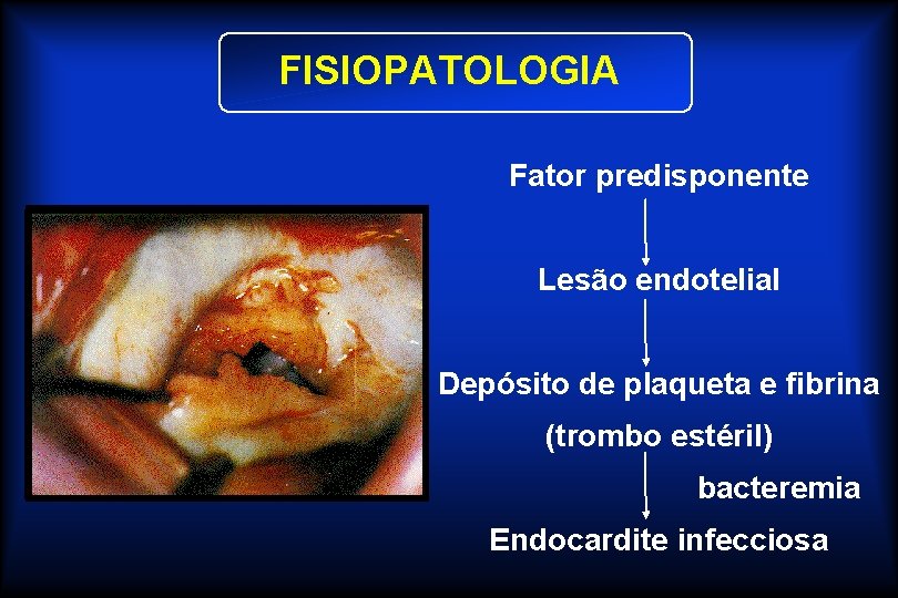 FISIOPATOLOGIA Fator predisponente Lesão endotelial Depósito de plaqueta e fibrina (trombo estéril) bacteremia Endocardite