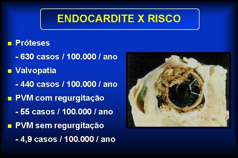 ENDOCARDITE X RISCO n Próteses - 630 casos / 100. 000 / ano n