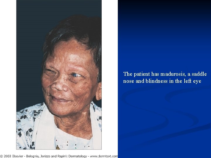 The patient has madurosis, a saddle nose and blindness in the left eye 