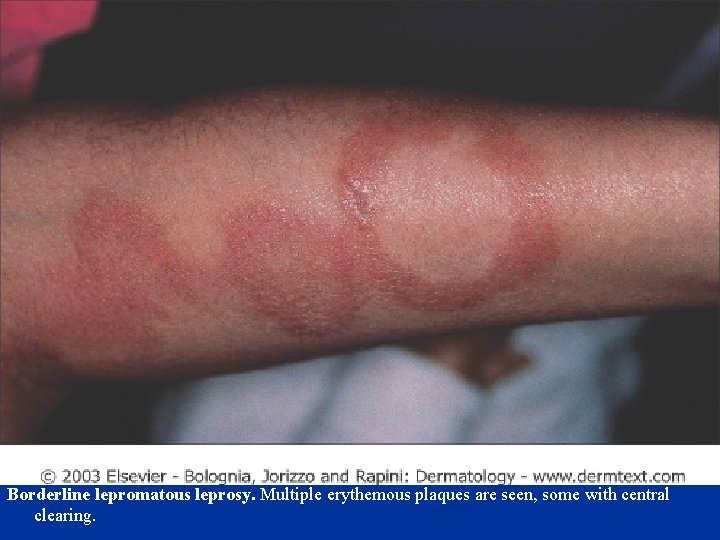 Borderline lepromatous leprosy. Multiple erythemous plaques are seen, some with central clearing. 