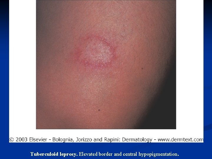 Tuberculoid leprosy. Elevated border and central hypopigmentation . 