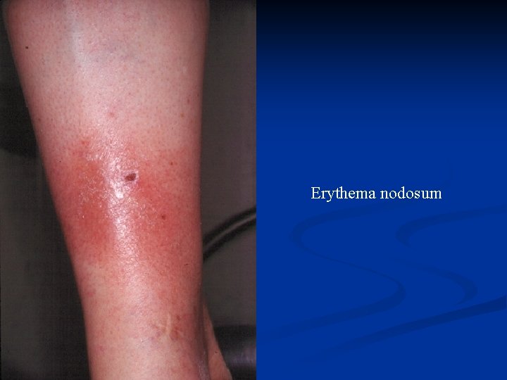 Erythema nodosum 