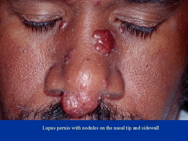 Lupus pernio with nodules on the nasal tip and sidewall 