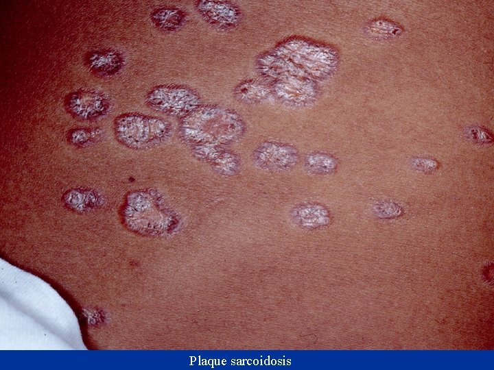 Plaque sarcoidosis 