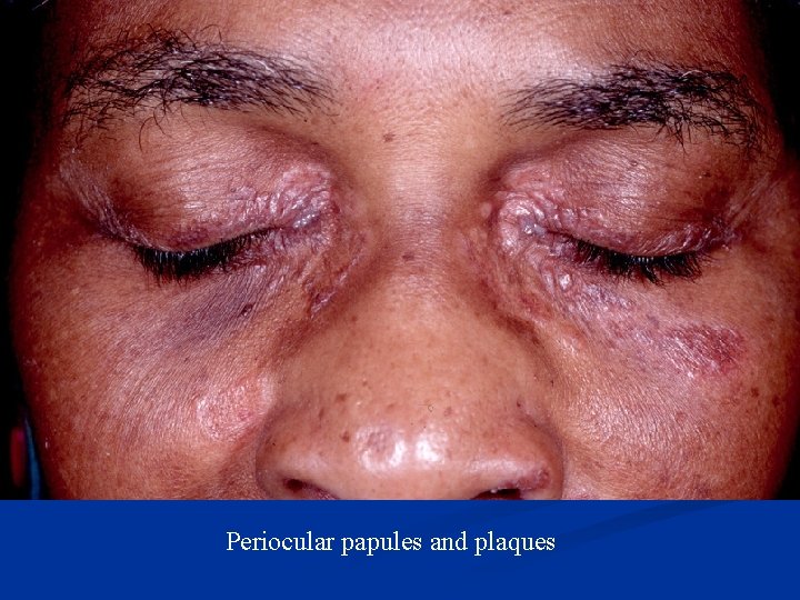 Periocular papules and plaques 