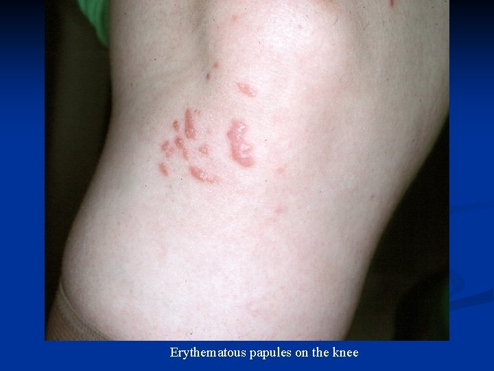 Erythematous papules on the knee 