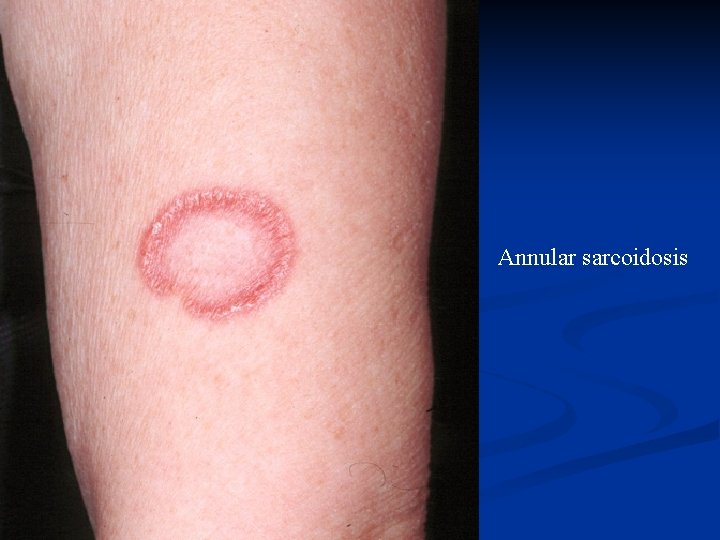 Annular sarcoidosis 