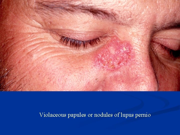 Violaceous papules or nodules of lupus pernio 